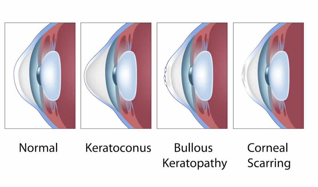 Common corneal conditions, eye cornea diseases